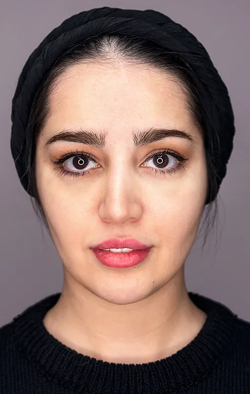 تزریق ژل لب قبل