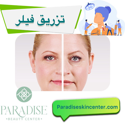 فیلر