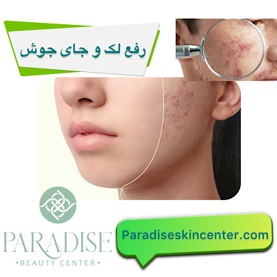 رفع لک و جای جوش