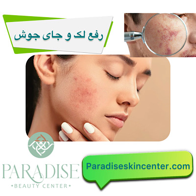 رفع لک و جای جوش
