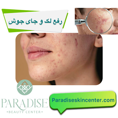 رفع لک و جای جوش