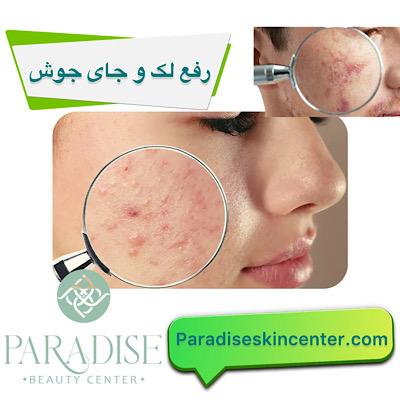 رفع لک و جای جوش