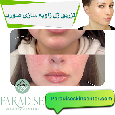 تزریق ژل و فیلر برای زاویه‌سازی