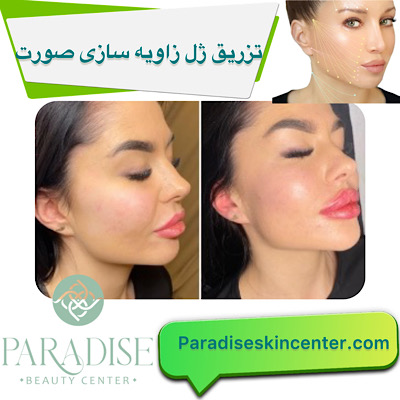 تزریق ژل و فیلر برای زاویه‌سازی