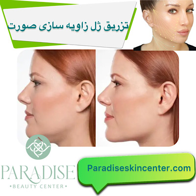 تزریق ژل و فیلر برای زاویه‌سازی