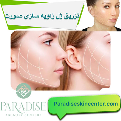 تزریق ژل و فیلر برای زاویه‌سازی