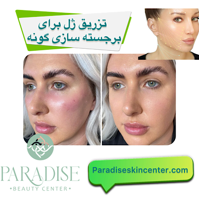 تزریق ژل برای برجسته‌سازی گونه‌ 