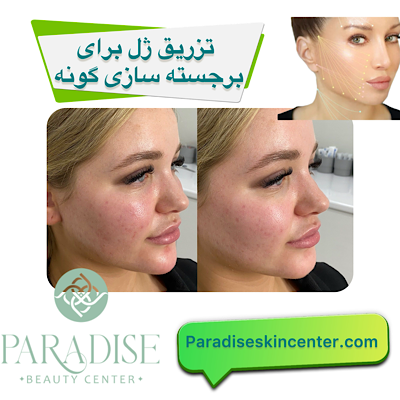 تزریق ژل برای برجسته‌سازی گونه‌ 