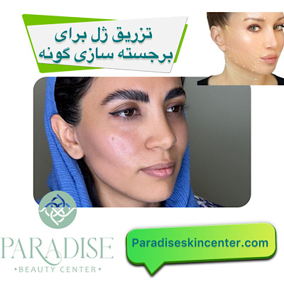 تزریق ژل برای برجسته‌سازی گونه‌ 