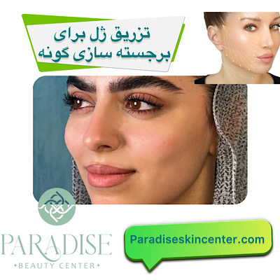 تزریق ژل برای برجسته‌سازی گونه‌ 