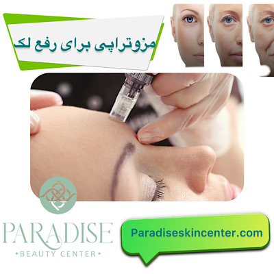 مزوتراپی برای رفع لک‌ 