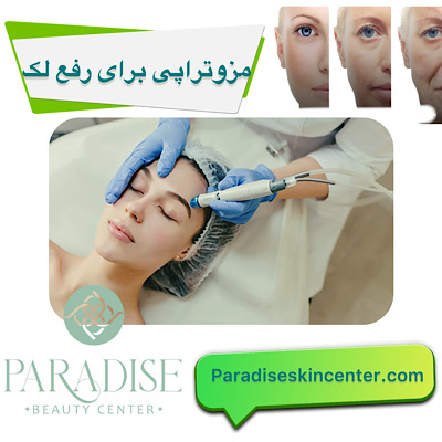 مزوتراپی برای رفع لک‌ 