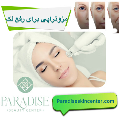 مزوتراپی برای رفع لک‌ 