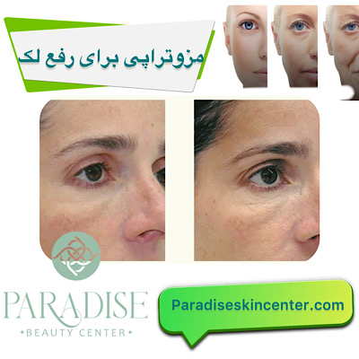 مزوتراپی برای رفع لک‌ 