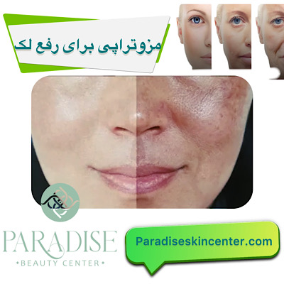 مزوتراپی برای رفع لک‌ 