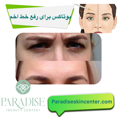 بوتاکس برای رفع خط اخم