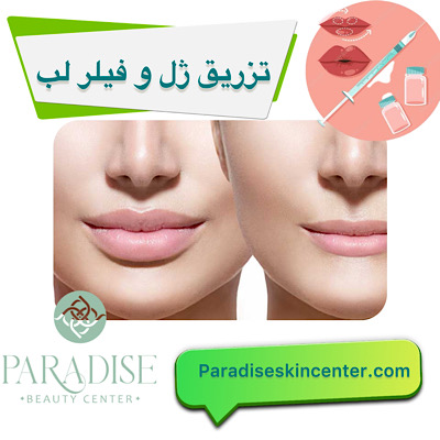 تزریق ژل و فیلر لب