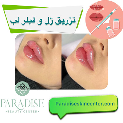 تزریق ژل و فیلر لب