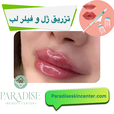 تزریق ژل و فیلر لب
