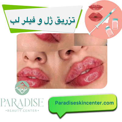 تزریق ژل و فیلر لب