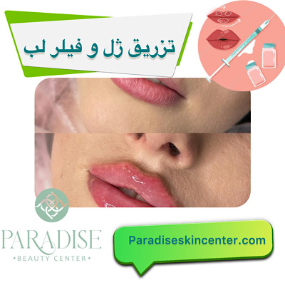 تزریق ژل و فیلر لب