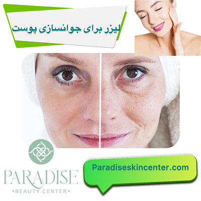 لیزر برای جوانسازی پوست