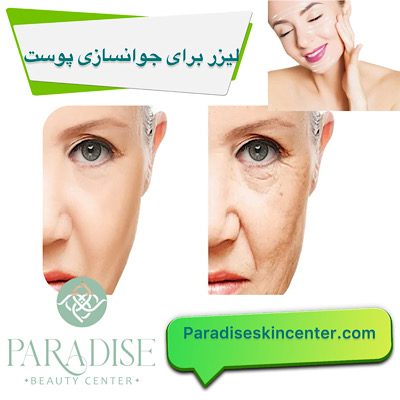 لیزر برای جوانسازی پوست