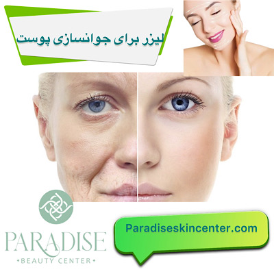 لیزر برای جوانسازی پوست