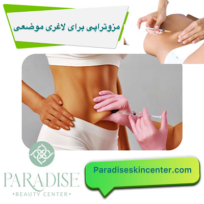 مزوتراپی برای لاغری موضعی