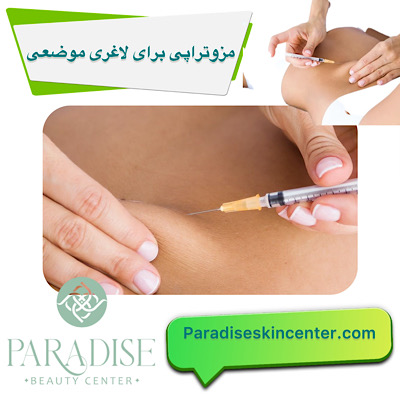 مزوتراپی برای لاغری موضعی