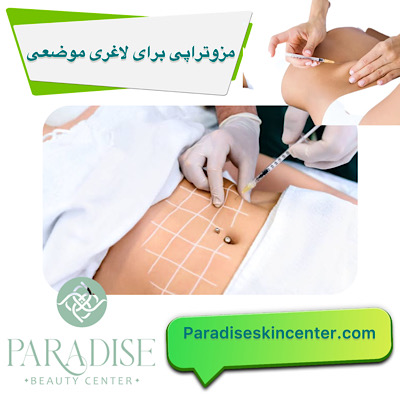 مزوتراپی برای لاغری موضعی