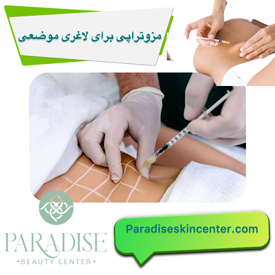 مزوتراپی برای لاغری موضعی