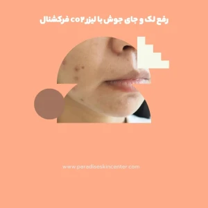 رفع لک و جای جوش با لیزر co2 فرکشنال