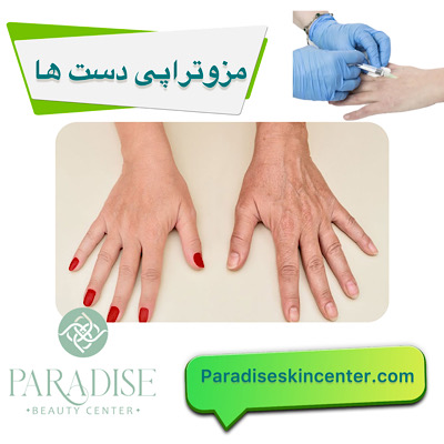 مزوتراپی دست‌ها