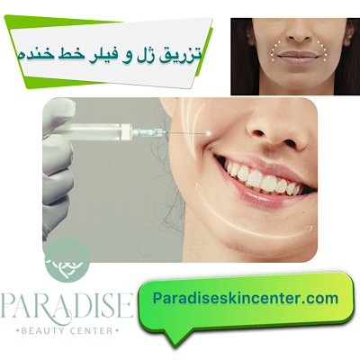 تزریق ژل و فیلر برای رفع خط خنده