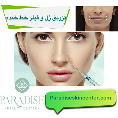 تزریق ژل و فیلر برای رفع خط خنده