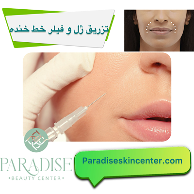 تزریق ژل و فیلر برای رفع خط خنده