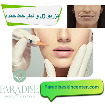 تزریق ژل و فیلر برای رفع خط خنده
