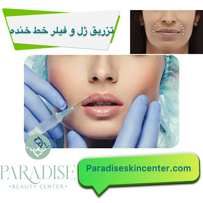 تزریق ژل و فیلر برای رفع خط خنده