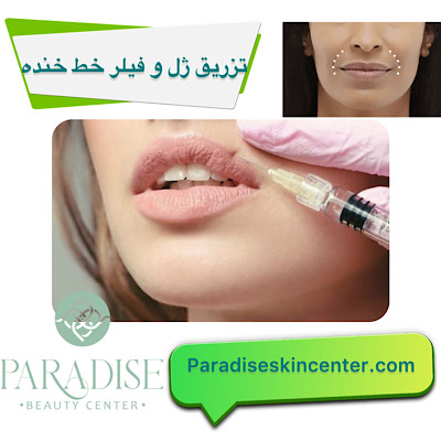 تزریق ژل و فیلر برای رفع خط خنده