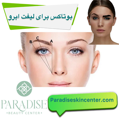 بوتاکس برای لیفت ابرو