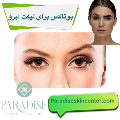 بوتاکس برای لیفت ابرو