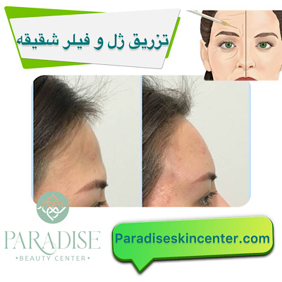 تزریق ژل و فیلر در شقیقهها