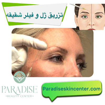 تزریق ژل و فیلر در شقیقهها
