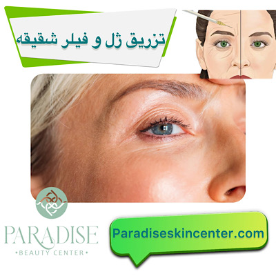 تزریق ژل و فیلر در شقیقهها