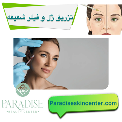 تزریق ژل و فیلر در شقیقهها