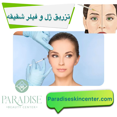 تزریق ژل و فیلر در شقیقهها