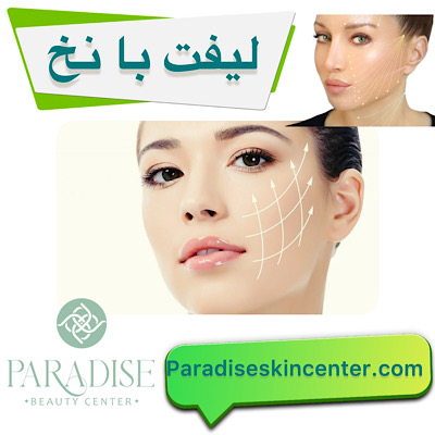 لیفت با نخ