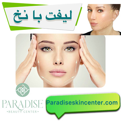 لیفت با نخ