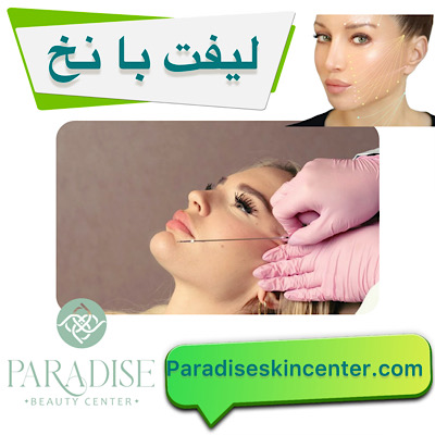لیفت با نخ